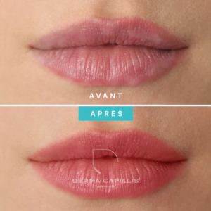 Résultat bouche pulpeuse maquillage permanent avant et après