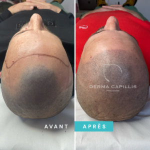 Résultat cheveux tricopigmentation avant et après