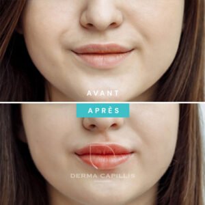 Résultat lèvres maquillage semi permanent avant et après
